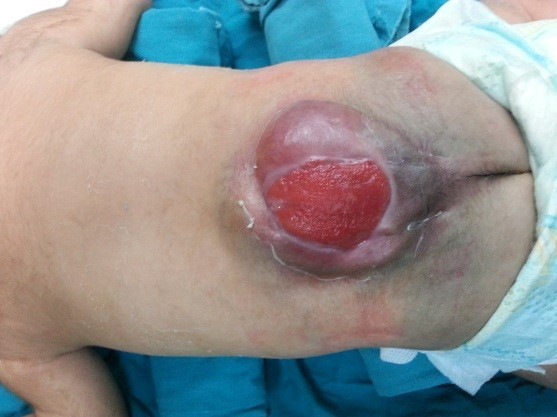 القيلة المائية الظهرية - أنواعها وكيفية علاجها