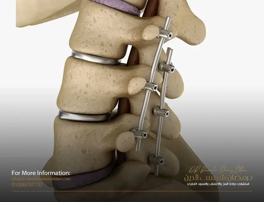 معلومات عن الرعاية المنزلية بعد عمليات التثبيت للفقرات القطنية - العجزية