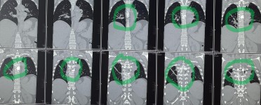 مريضة عمرها 43 عام تعاني من ضعف متزايد بالطرفين السفليين.