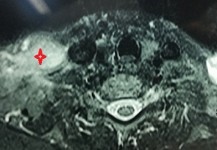 ورم  بالضفيرة العصبية العنقية اليمني