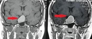 ورم بقاع الجمجة ضاغط علي العصب البصري الايمن
