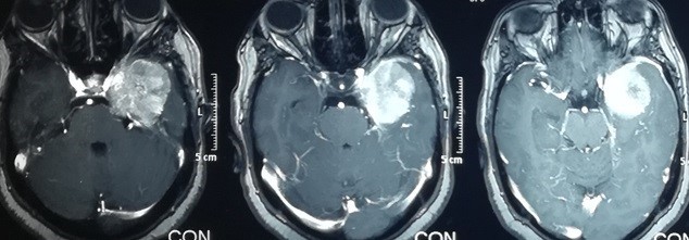 ورم سحائي بقاع الجمجمةبالفص الصدغي الايسر