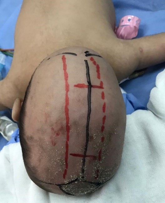 استئصال الدرز السهمي بالمنظار