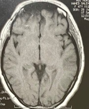 ورم بالفص الامامي بقاع الجمجمة