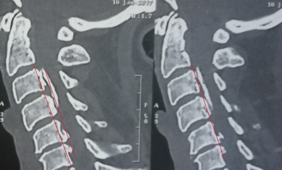 تعظم الام الجافية بالنخاع الشوكي للفقرات العنقية