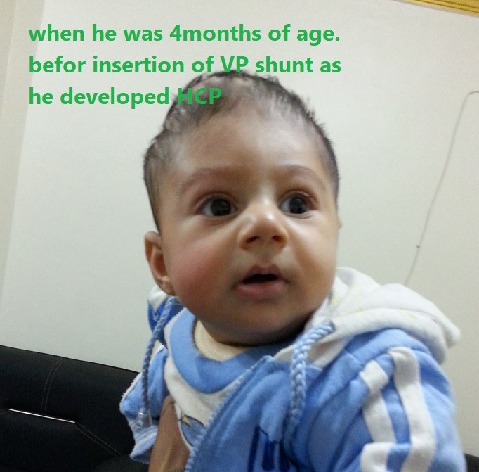 قيلة مخية سحائية