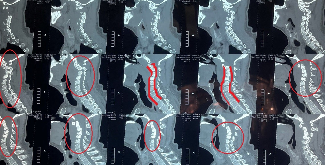 اصلاح تحدب بالفقرات العنقية
