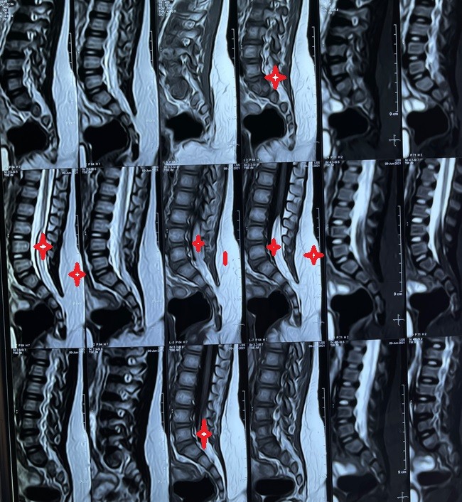 ورم دهني خلقي بالفقرات القطنيىة