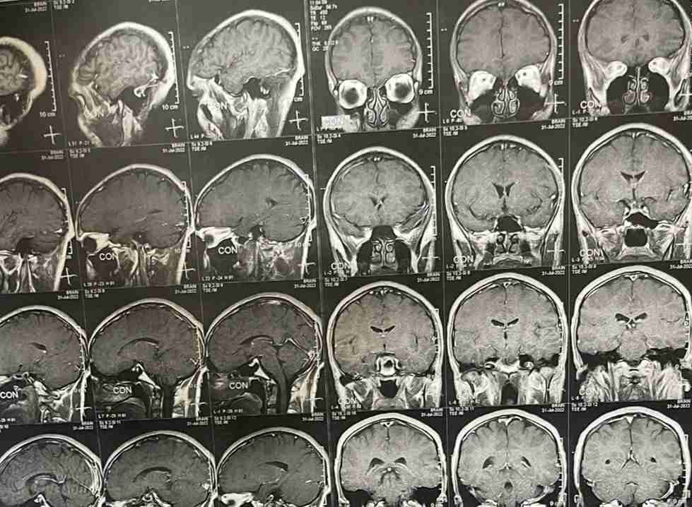 cpa  ورم بالحجرة الخلفية بالمخ مؤثر علي عصب الاتزان وعضلات الوجه