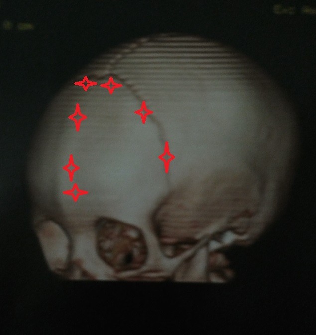 انسداد مبكر للدرزين الاكليليين والدرز الجبهي