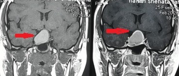 ورم بقاع الجمجمة ضاغط علي العصب البصري الايمن