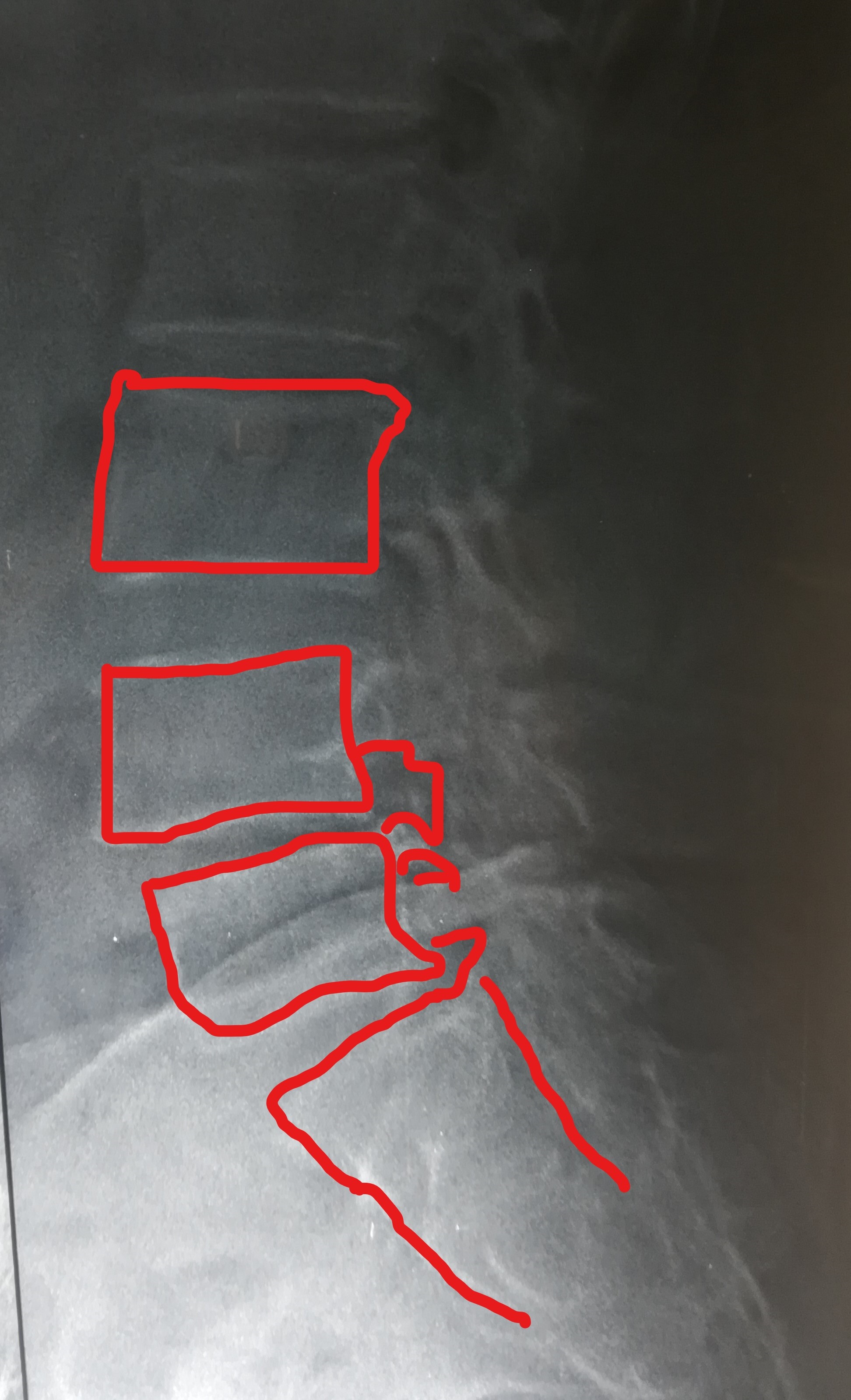 ضيق بالقناة العصبية القطنية مستويات متعددة مع تزحزح فقاري قبل وبعد الجراحة