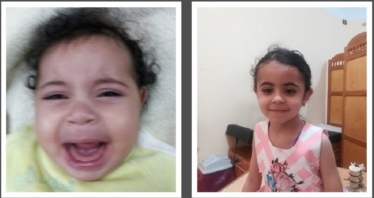 انغلاق مبكر للدرزين الاكليليين مع جبهه صغيرة في طفلة 4 شهور