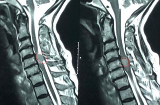 ورم سحائي بالنخاع الشوكي العنقي
