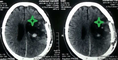 نزيف بالنصف الكروي الايسر بالمخ ممتد لبطينات المخ