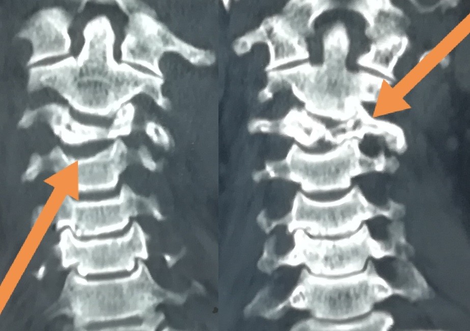 تثبيت امامي لكسر وتاكل بجسم الفقرة الثالثة العنقية