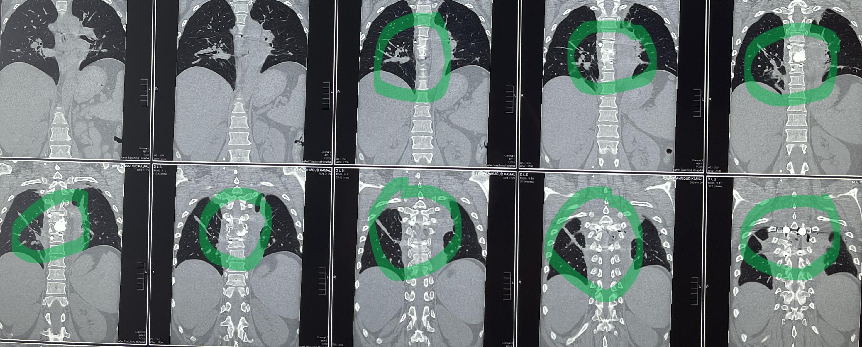 مريضة عمرها 43 عام تعاني من ضعف متزايد بالطرفين السفليين.