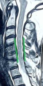 انزلاق غضروفي عنقي متعدد