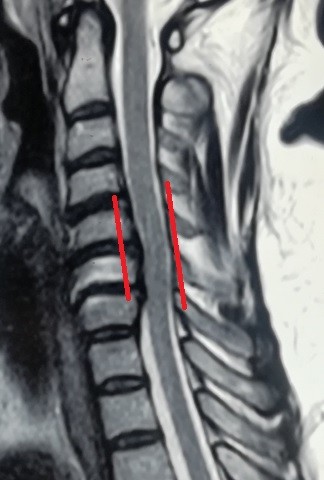 انزلاق غضروفي عنقي متعدد قبل وبعد الجراحة