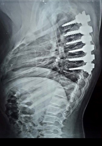 تحدب بالفقرات الصدرية