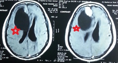 ورم سحائي بالفص الايمن بالمخ