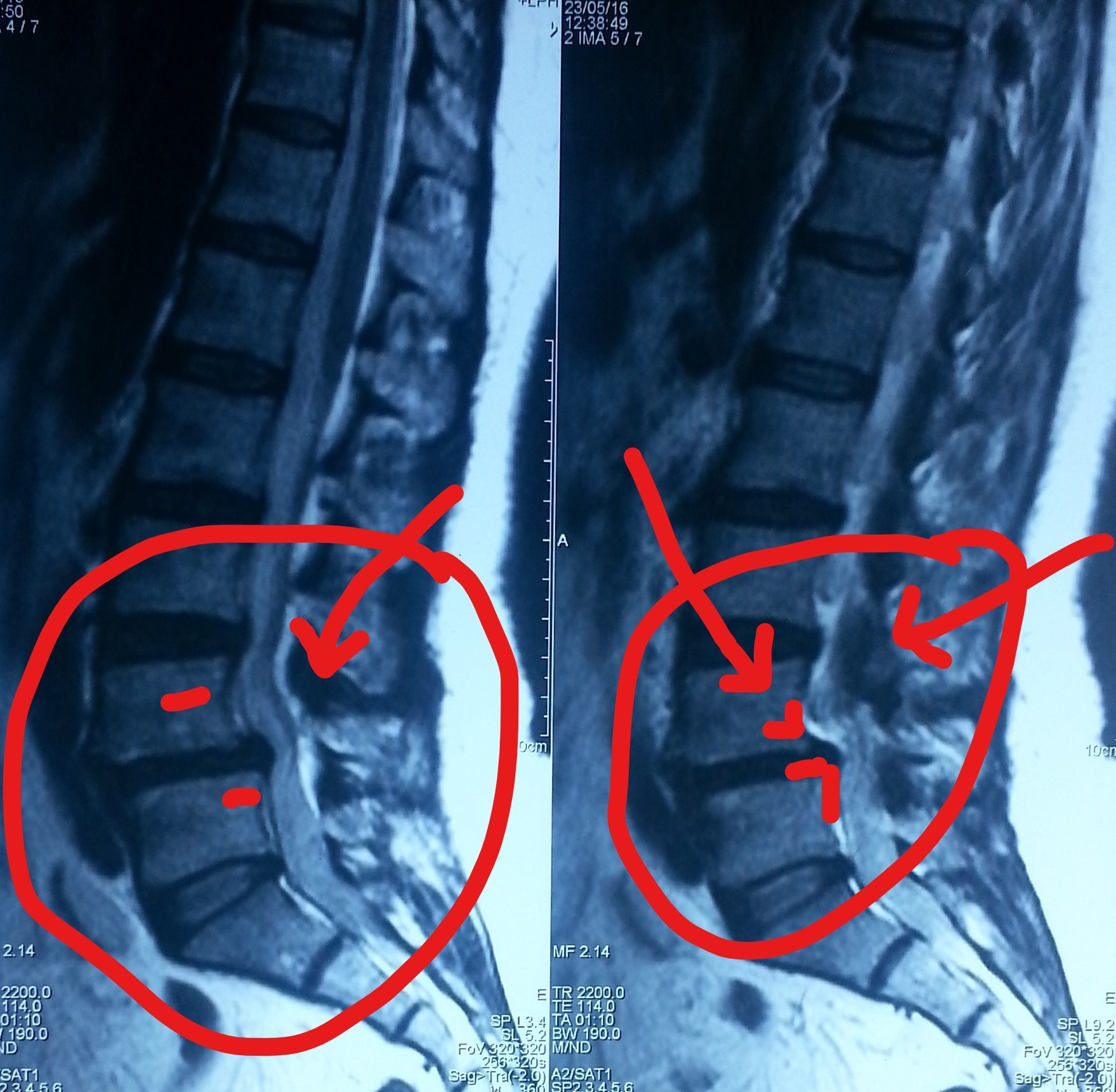 تزحزح بالفقرات القطنية مع ضيق بالقناة العصبية قبل وبعد الجراحة