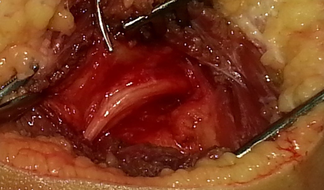 عصب عرق النسا الايمن بعد اصابة بحقن عضلي