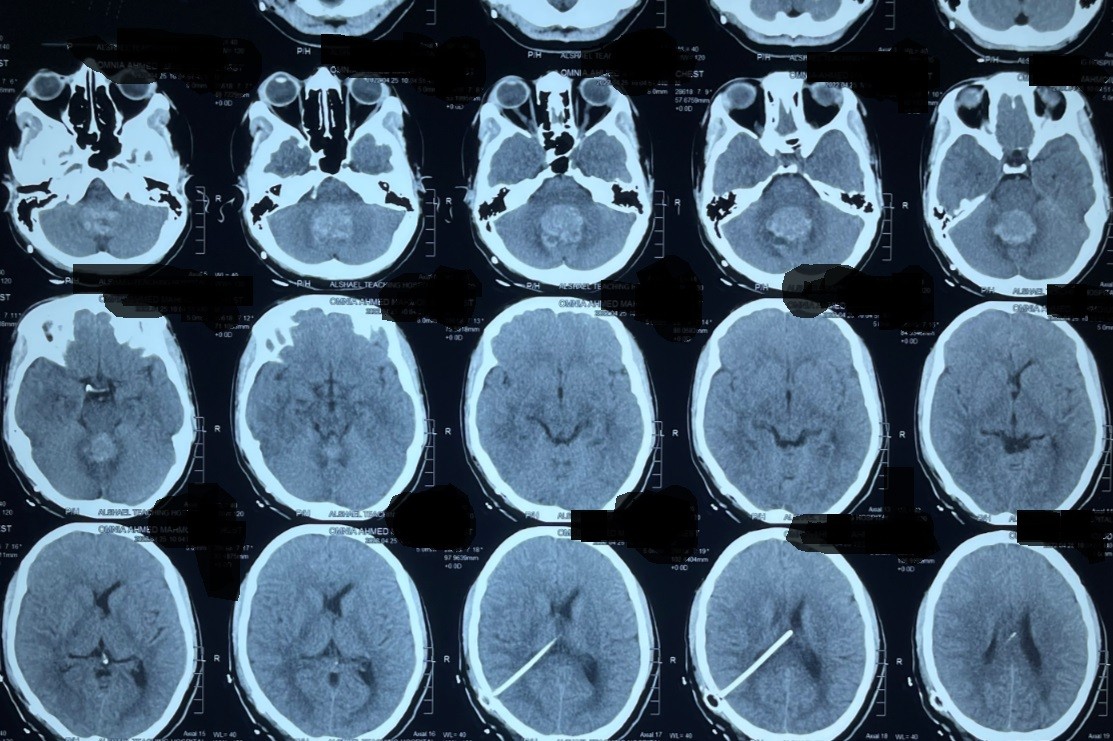 medulloblastomaورم بالحجرة الخلفية بالمخ