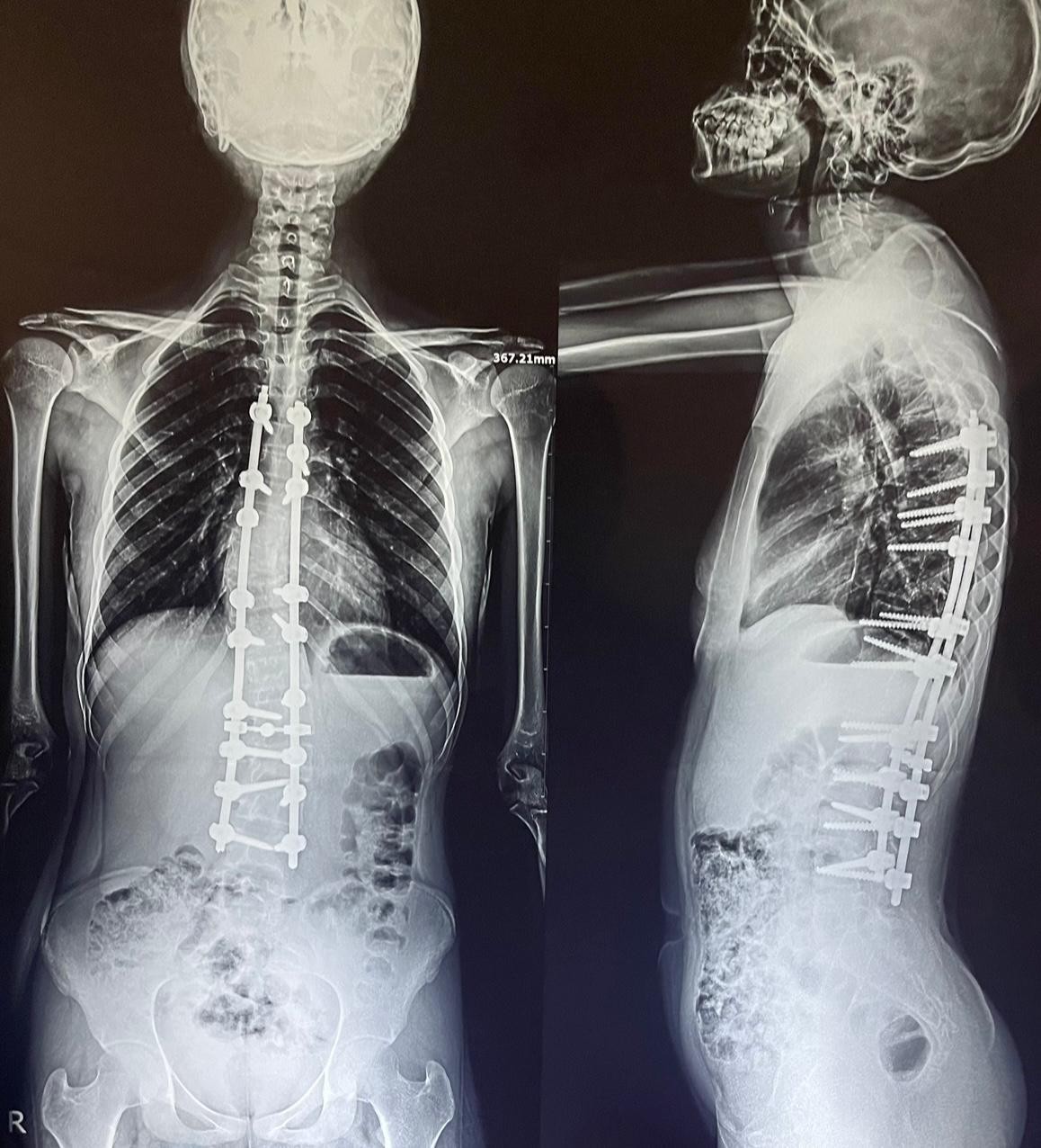 اعوجاج مزدوج بالفقرات الصدرية و القطنية