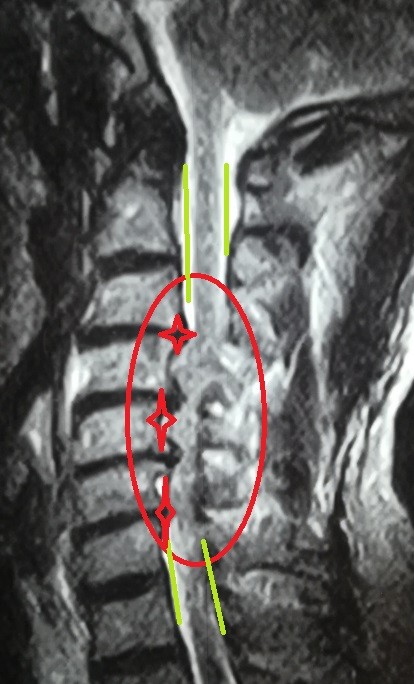 توسيع ضيق بالقناة العصبية العنقية