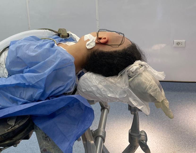 مرض ورم تنسج ليفي عظمي بفتاة واحد وعشرين عاما