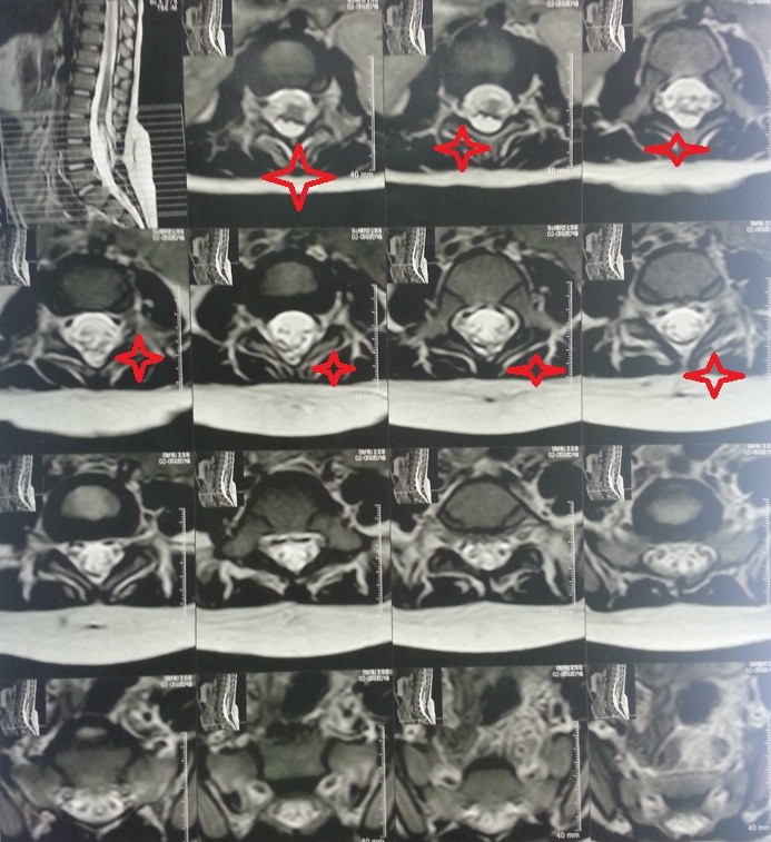 ورم دهني خلقي بالنخاع الشوكي مقابل الفقرات القطنية بطفلة اربع اعوام
