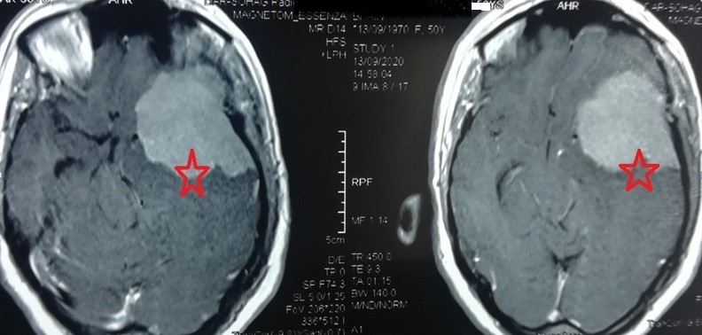 ورم سحائي ضخم بقاع الجمجمة بالجهة اليسري الصدغية